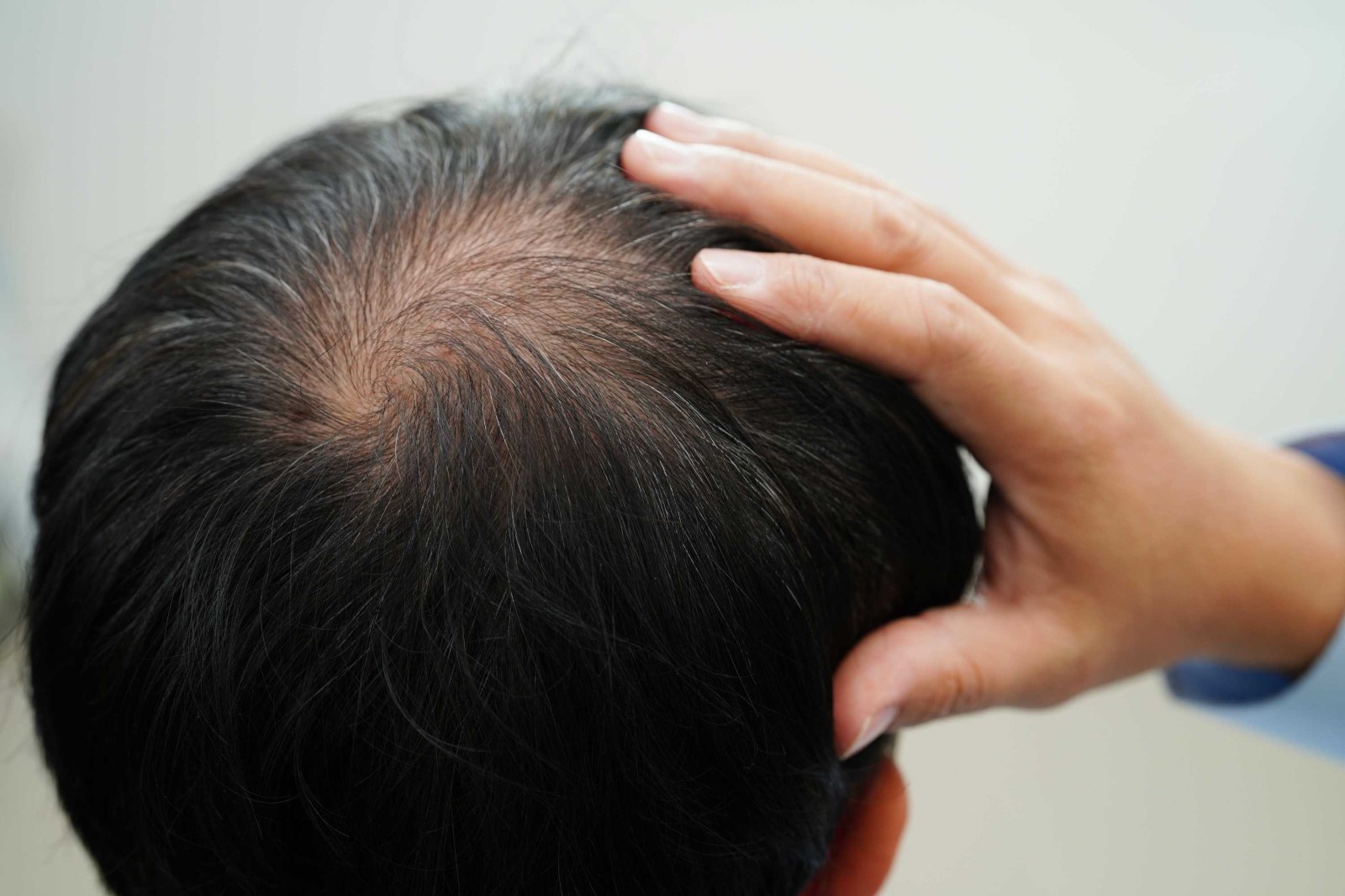 Wat als je geen haartransplantatie doet